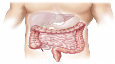 Obstrucción intestinal: qué es y cuáles son sus señales de alerta