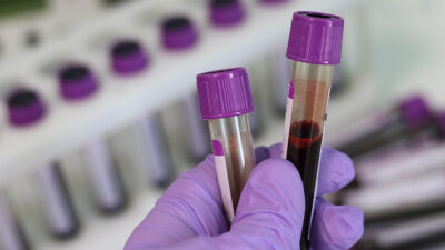 Crean test de sangre que identifica el cáncer y si éste se ha propagado