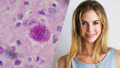 Toxoplasma Gondii parásito que te hace sexy