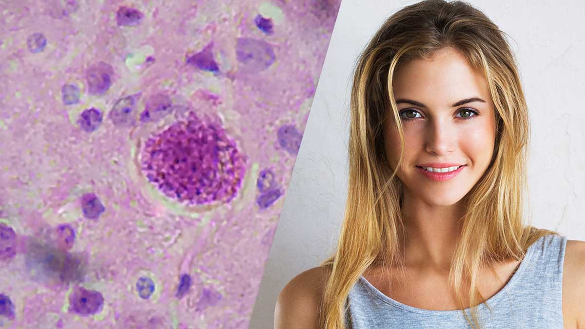 Toxoplasma Gondii parásito que te hace sexy
