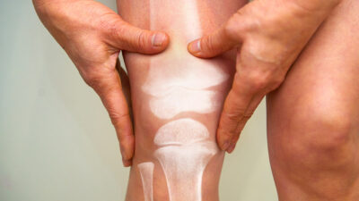 Osteoporosis: qué es y se puede prevenir, según la UNAM