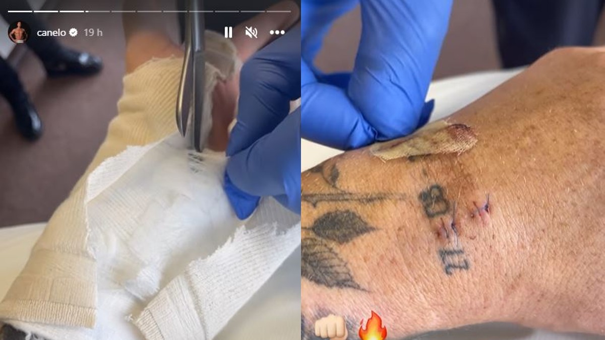 “Canelo” Álvarez muestra cómo quedó su mano tras operación