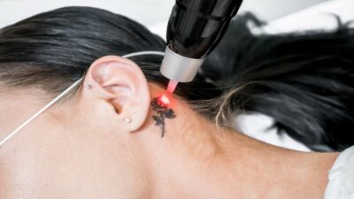 Mujer se arrepiente y elimina tatuajes de su cara con láser