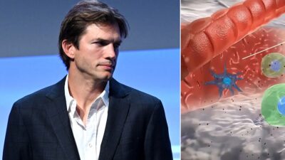 Vasculitis: qué es la extraña enfermedad que padece Ashton Kutcher