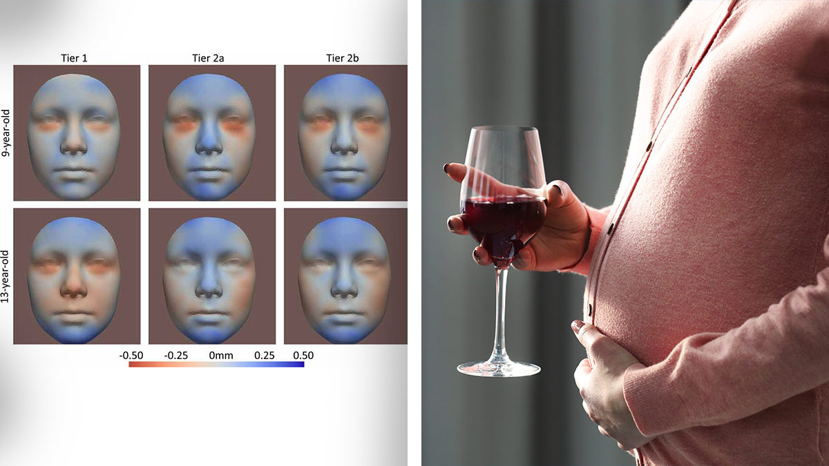 Diversidad roble apaciguar Consumo de alcohol durante el embarazo se relaciona con cambios en la cara  del bebé