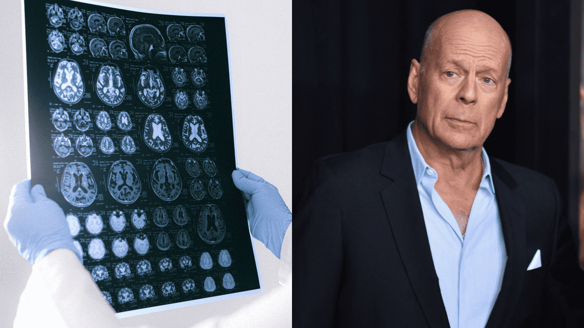 ¿Qué es la demencia frontotemporal que padece Bruce Willis? Estas son las señales de alerta