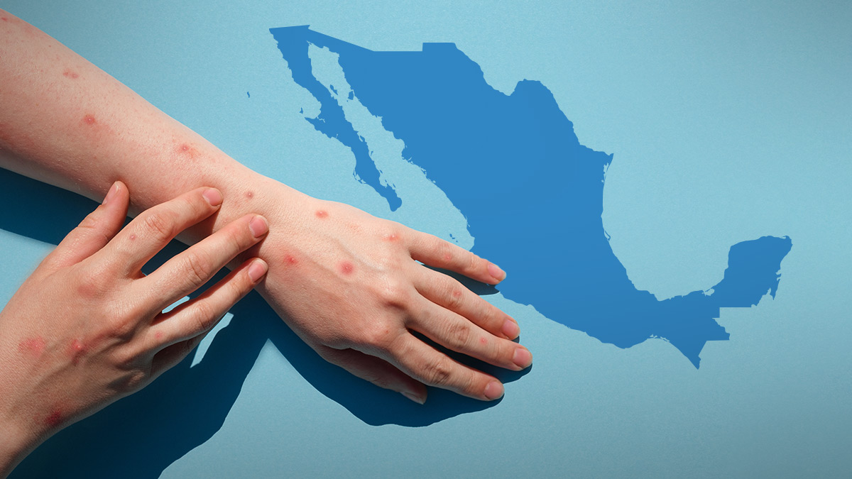 Viruela del mono en México: 60 casos confirmados de mpox en los últimos 14 días, según Salud
