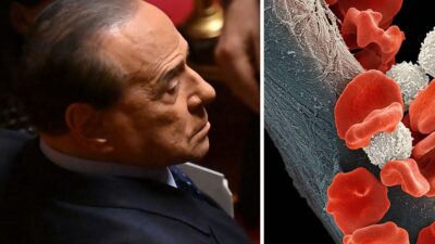 Leucemia mielomonocítica crónica de Silvio Berlusconi
