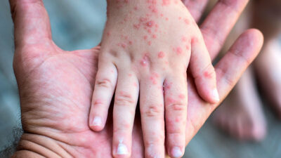 Rebrote de poliomielitis y sarampion por falta de vacunacion