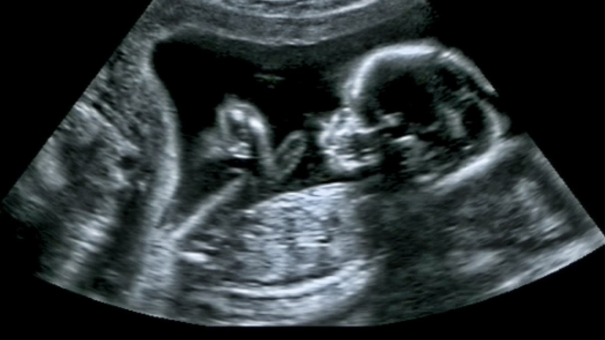 Por qué los expertos desaconsejan el uso de aparatos caseros para escuchar  el corazón del feto? - BBC News Mundo