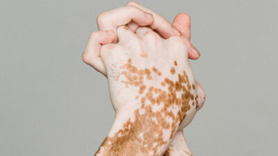 Vitiligo: aprueban venta de crema para la repigmentación