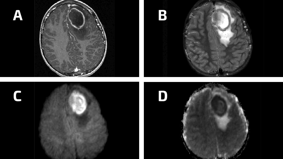 infecciones cerebrales