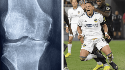 ¿Qué es la rotura de ligamento cruzado anterior de la rodilla?